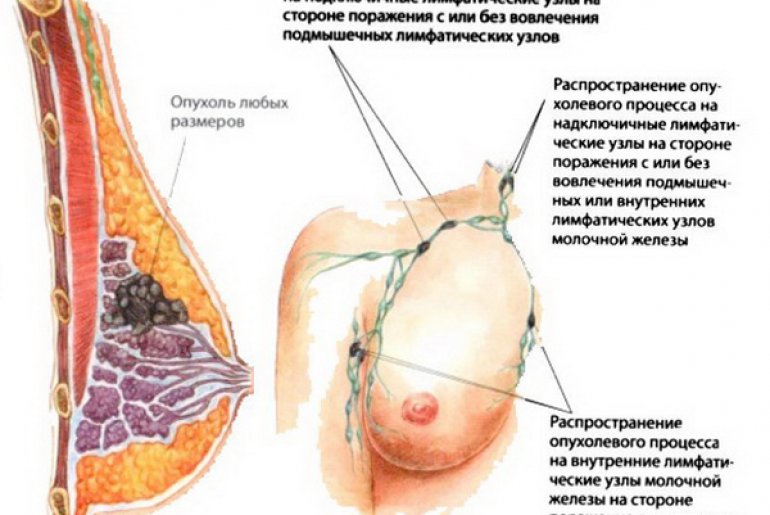 Рак груди: симптомы, виды, лечение