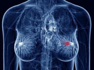 Причины рака груди